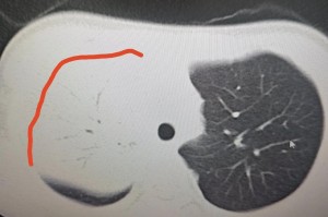 新疆肺炎〃新疆确诊肺炎