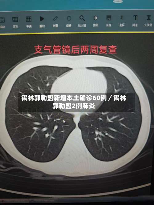 锡林郭勒盟新增本土确诊60例/锡林郭勒盟2例肺炎-第3张图片