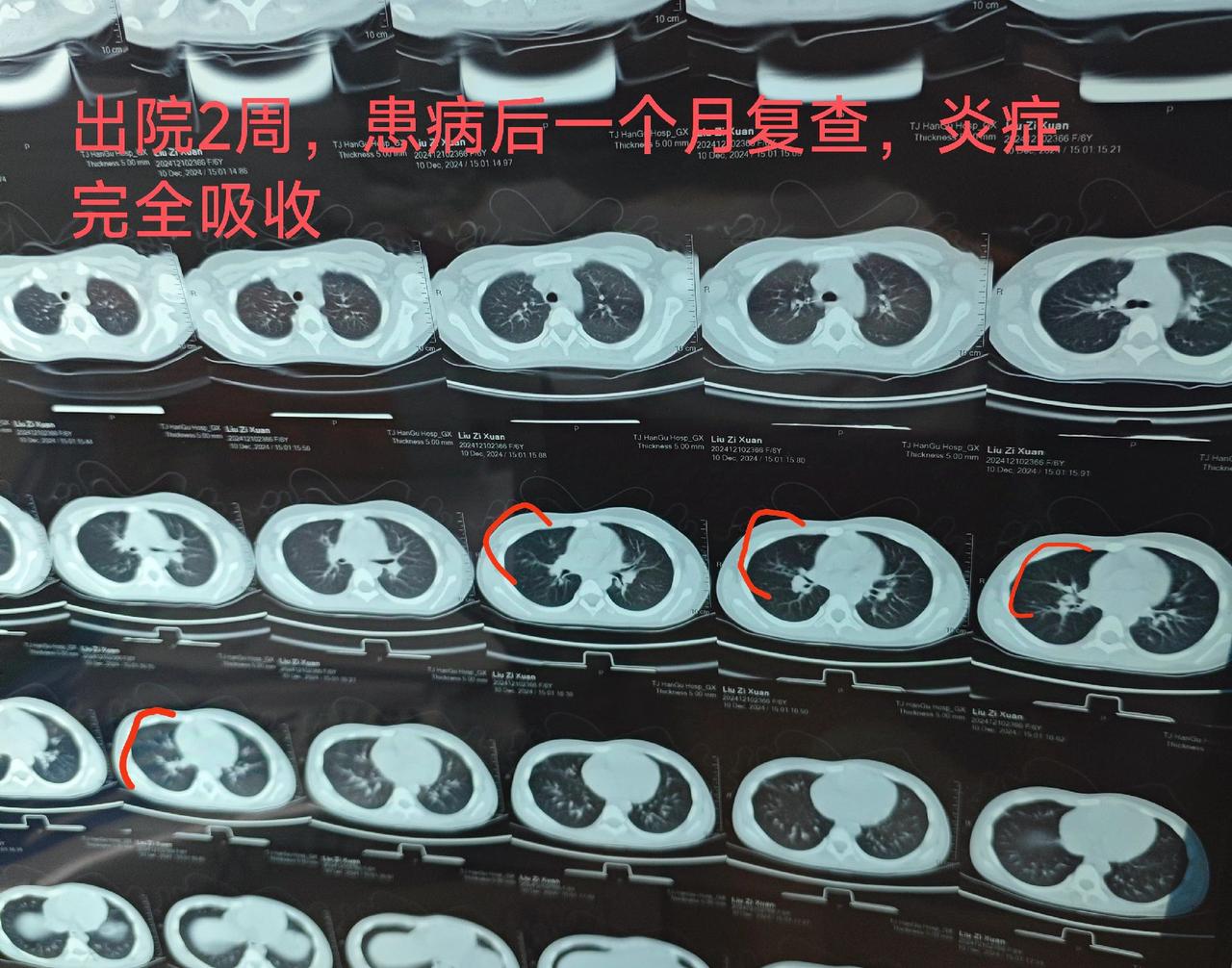 肺炎北京10例了,北京的肺炎情况-第2张图片