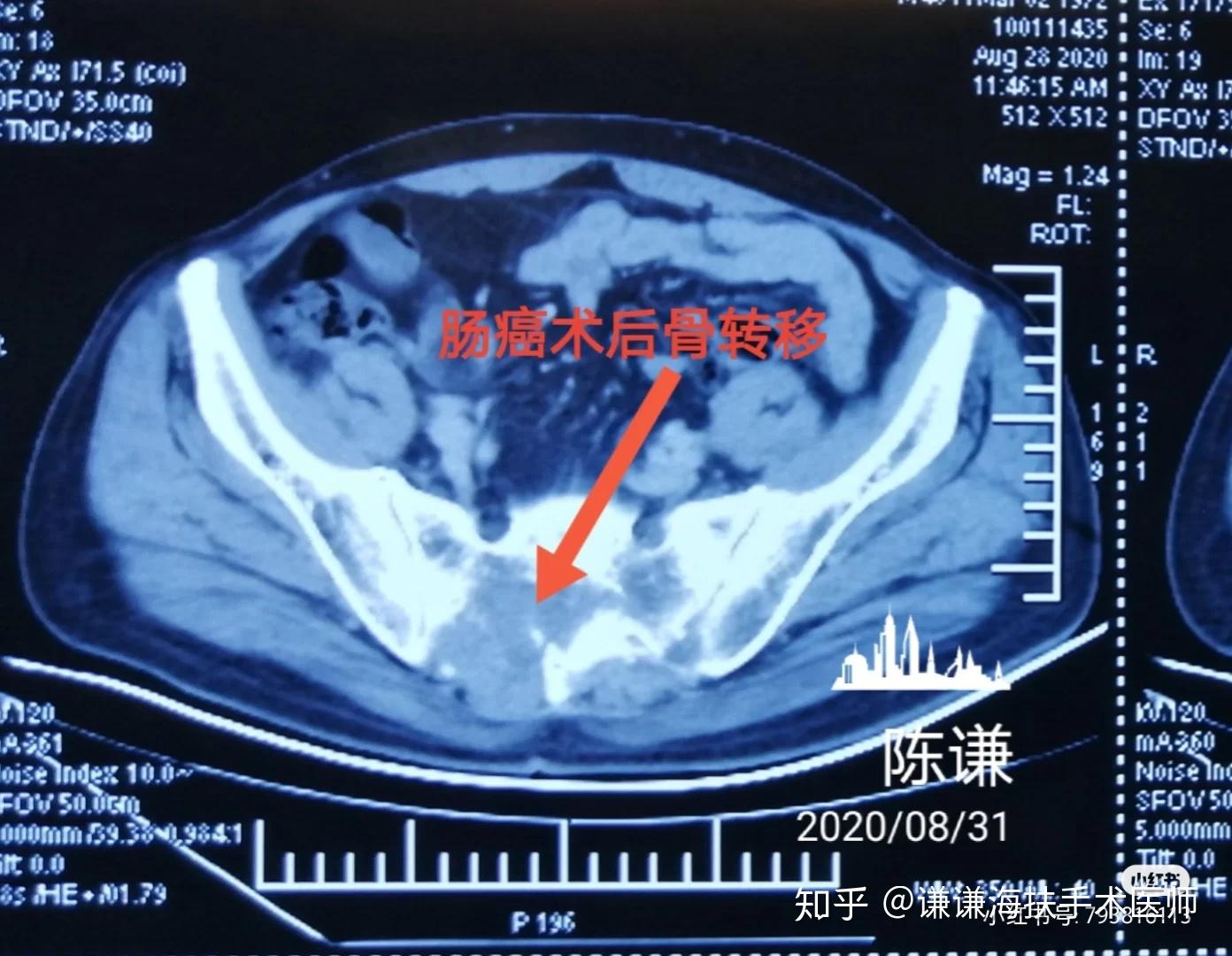 大连确诊︰(大连确诊直肠癌后可以买什么保险)-第2张图片